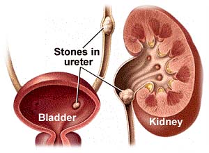 Blader stones-F