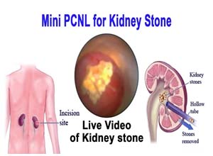 Mini-PCNL