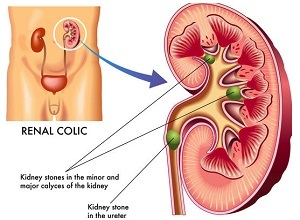 Ureteric Stones