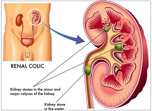 Ureteric Stones
